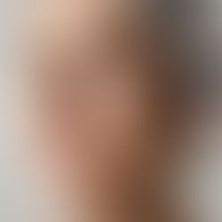 Thread Lift vs Facelift: Which One Is Right for You?