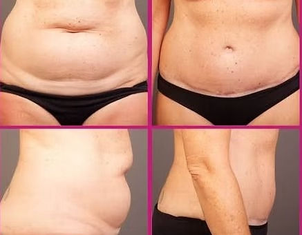 How Body Contouring Reduced Stubborn Belly Fat for a 40-Year-Old Client, Real Transformation at Skulpted by Kan...