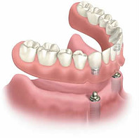 Dentures