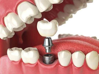 Como funcionam os implantes dentários