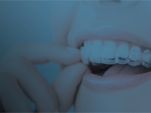 Allineatori Sorridi: la rivoluzione degli allineatori dentali per trattamenti ortodontici senza attachments