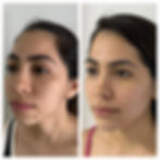 Antes e Depois de paciente real