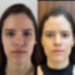 Antes e Depois de paciente real