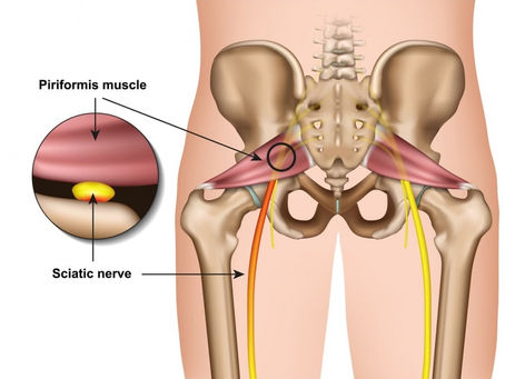 Acupuncture Treats Sciatica