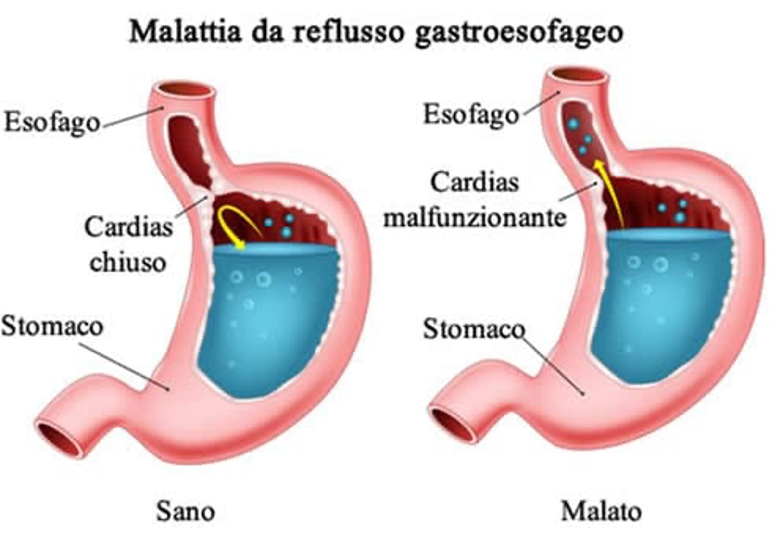 malattia del reflusso gastroesofageo
