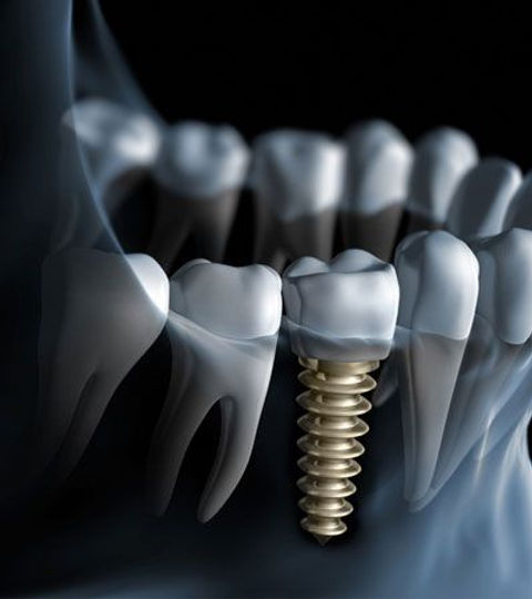 implantes-dentales-pamplona.jpg