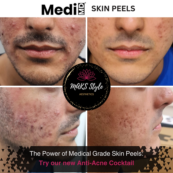 Acne treatment at MAKS Style Manchester