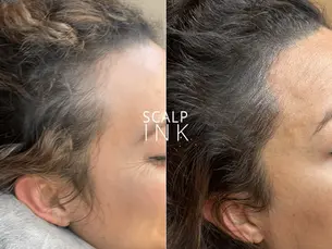 Scalp Micropigmentation for Women: A Revolutionary Solution for Hair Loss