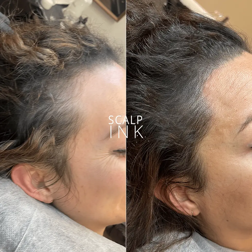 Scalp Micropigmentation for Women: A Revolutionary Solution for Hair Loss
