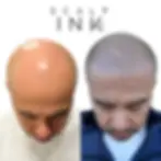 SCALP INK SMP Before After: transforming baldness