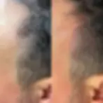 SMP Before After hair density
