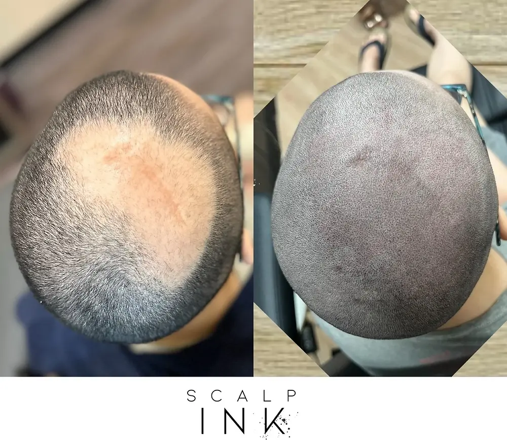 Before and after SMP Services Las Vegas for hair loss by Scalp Ink