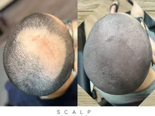 Busting Myths About Scar Camouflage Scalp Micropigmentation (SMP): The Facts You Need