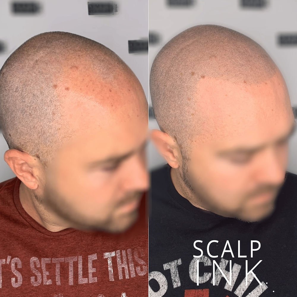 Before and after, man's scalp with SMP Services