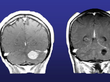 Metástases cerebrais