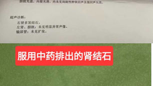 腎結石案例