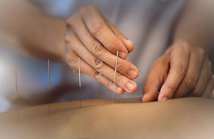 Acupuncture Close Up_edited.jpg