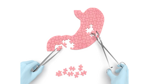 Dez mitos e verdades em cirurgia bariátrica
