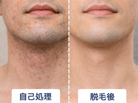 那覇・浦添で全身脱毛メンズの効果実感は何回？リアル解説