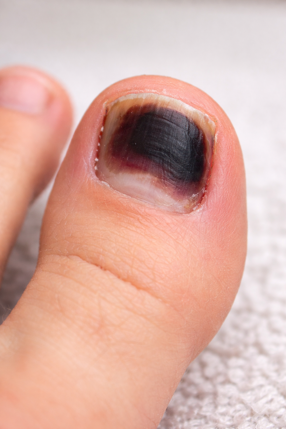 Close-up of a big toe with a black bruise under the nail, on a soft white surface, indicating possible injury or trauma.