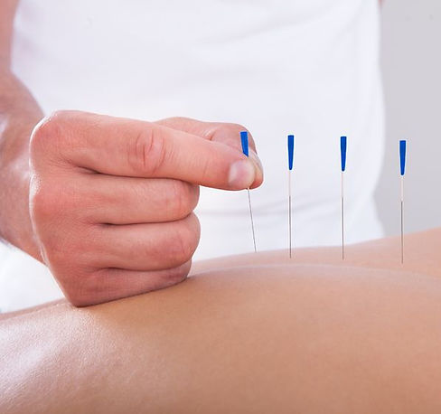 12149-acupuncture21253641_m_edited.jpg