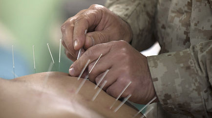Acupuncture-needle1.jpg