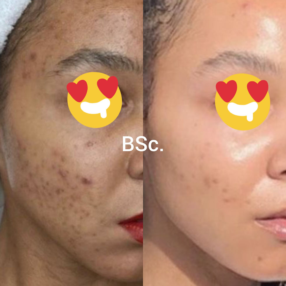 Thumbnail: Acne Line Package