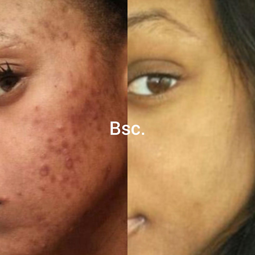 Thumbnail: Acne Line Package