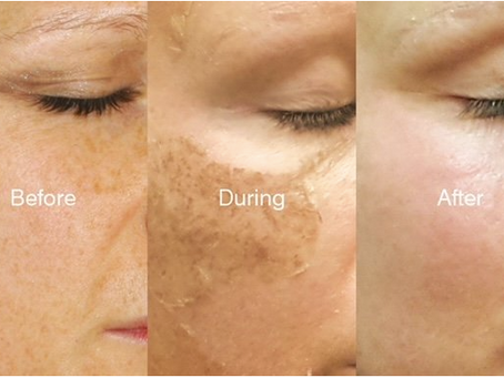 Before & After DMK Para Medical Peels