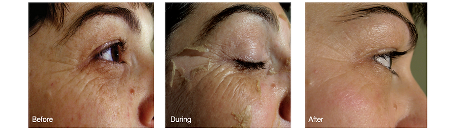 DMK Peels Dermal Aesthetic Clinic Ivanhoe