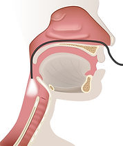 Graphic demonstrating Fiberoptic Endoscopic Evaluation of Swallowing (FEES)