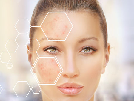 Can Acne Be Treated By Licensed Estheticians?