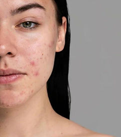 The Natural Way To Fade Acne Scars (1).jpeg