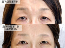 眼瞼下垂 (眉下切開術)で出来た傷跡は、アートメイクで隠せます。