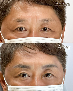 施術前と施術後の比較