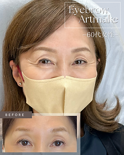 施術前と施術後の比較