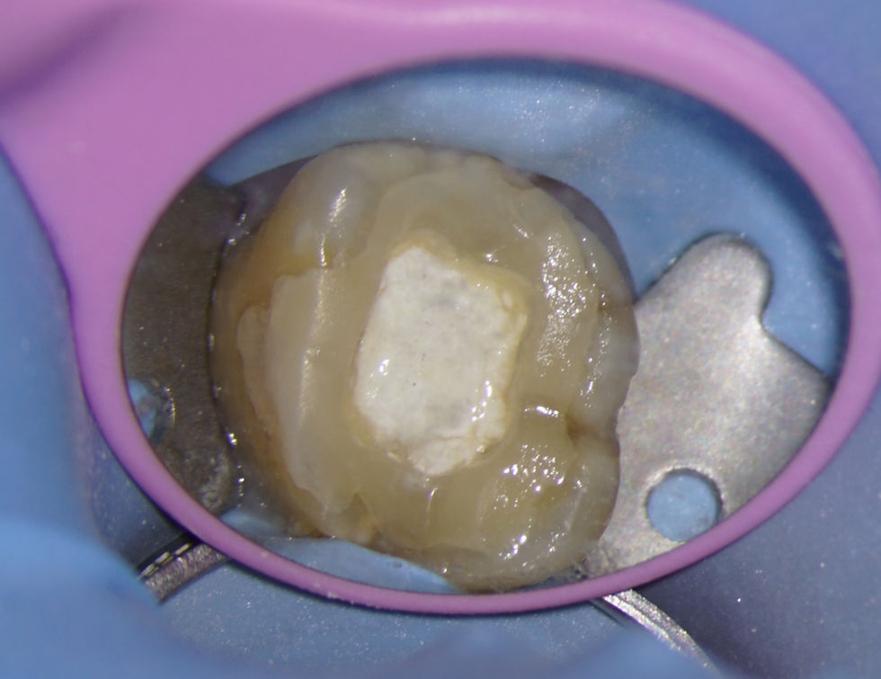 Multiple restorations - let's remove all the restorative and see what lies beneath!