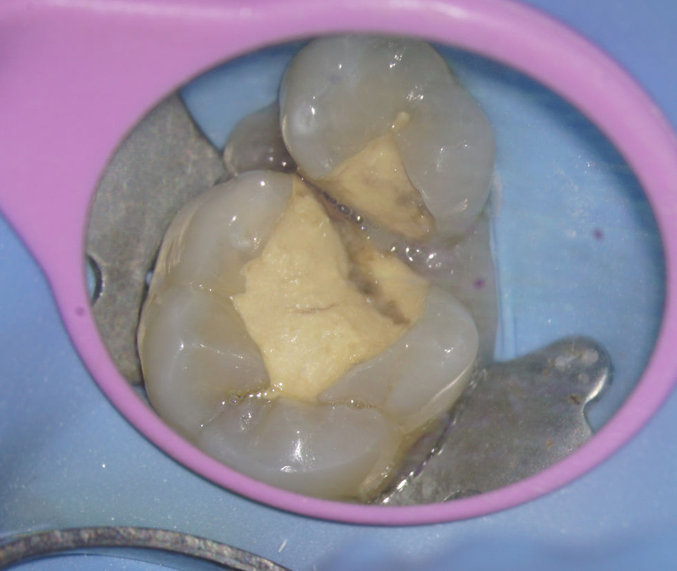 Presenting situation biodentine breaking down as placed a few months earlier