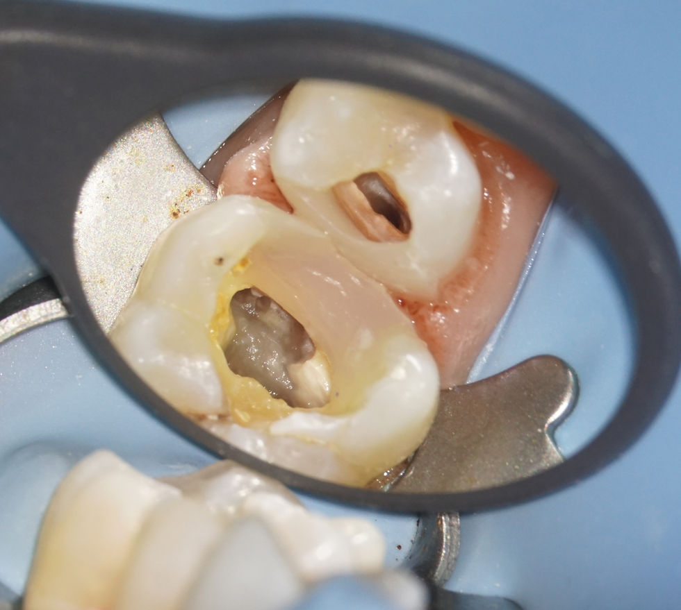All biodentine removed, pulps accessed and covered with PTFE, walls rebuilt with sectional matrix bands and SDR Flow + Composite from Dentsply.