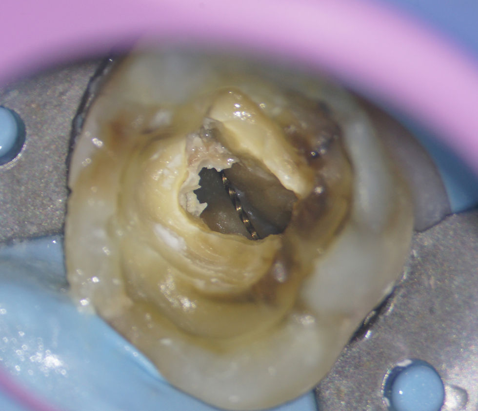 As the pulp chamber is unroofed, the tip of the Wave One Gold file begins to be uncovered and removal is straightorward with the use of ultrasonics (Satellec 10z tip).