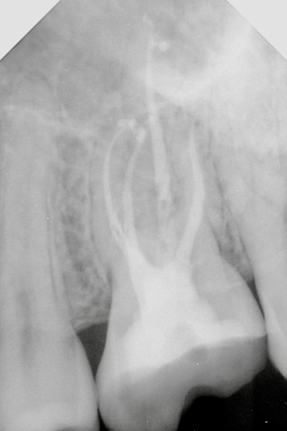Four canals filled to length, well sealed at all apices with a small sealer puff.