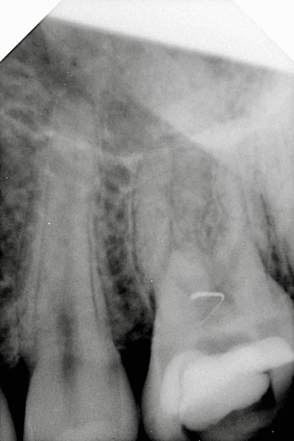 Presenting situation. Multiple restorations and separated instrument in canal orifice