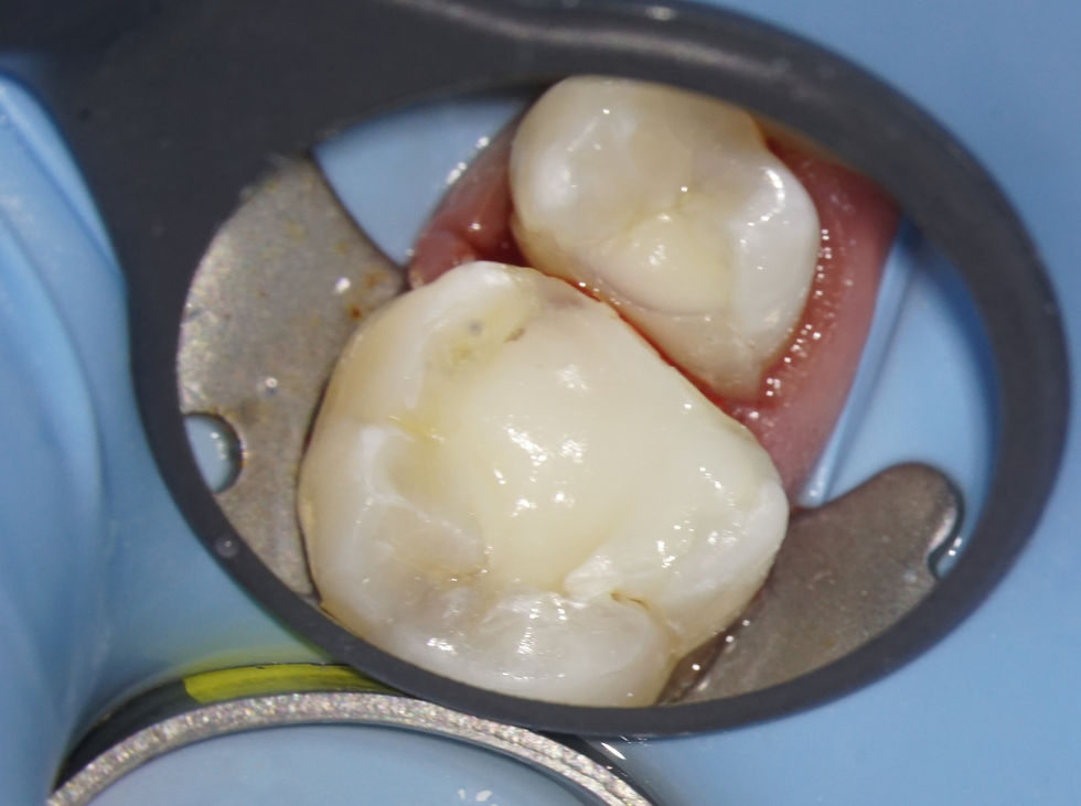 Dual-cure Composite cores (Luxacore Z Dual from DMG).