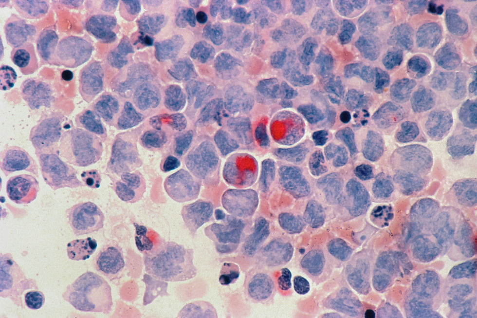 Microscopic view of cancer cells for specialist care