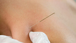 Unleashing Athletic Potential: How Dry Needling May Help