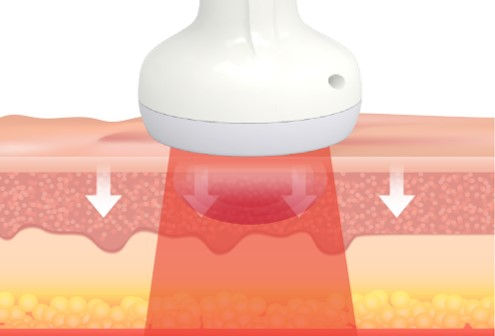 LED BIPOLAR