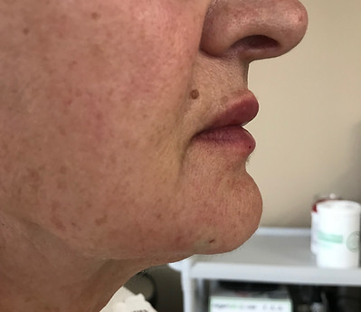 Jaw Line Definition After Photo