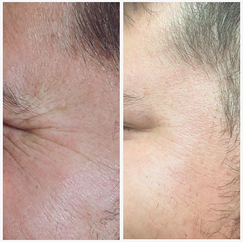 Male Botox Before and Afer Crows Feet