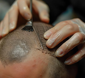 Scalp-Micro-Pigmentation .jpeg