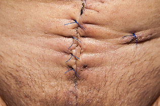 abdominal scar